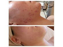 マニカルデシロカネ(MANICALDE白金)の雰囲気(大人の肌トラブルに丁寧に向き合います#フェイシャル#ニキビ)