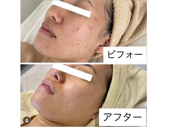 ヴィクトリアサロン(VICTORIA SALON)/治すだけではなくできないお肌に