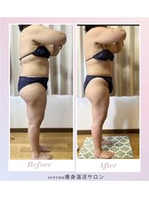 セレーナ(Serena)/初回→5回の変化(脚/ヒップ施術)