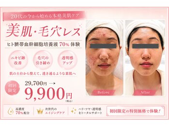 イーズ ミュゼ &nbsp;ららぽーと横浜店の写真/『毛穴レス艶肌☆ホワイトピーリング¥5500』乳酸ピール×幹細胞×高濃度ピュアビタミンCで集中美白！