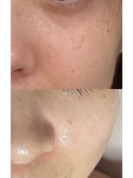 ユウビビューティサロン 東生駒(Yuubi Beauty Salon)/【peel stage】ハーブピーリング