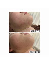 ホワイトアクア 加古川店(WHITE AQUA)/ハーブピーリングで肌荒れ改善