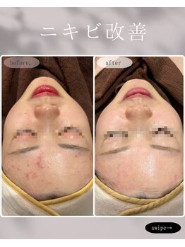 レア 姫路店(le'a)/根本的な肌質改善を目指す方へ