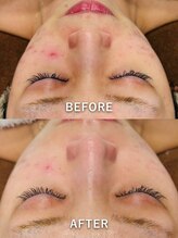 ルーク(Luke)/ニキビケア／くすみ／毛穴