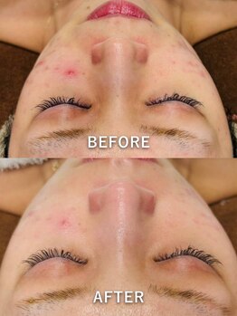 ルーク(Luke)/ニキビケア／くすみ／毛穴