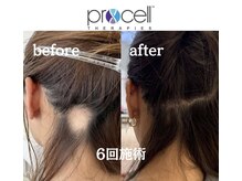 カナウ睡眠頭皮研究ラボ/【育毛促進】施術6回