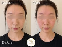 プリュボーテ(Pul Beaute)の雰囲気（頭皮からググッと引上げる♪感動の結果 小顔｜小顔矯正｜たるみ）