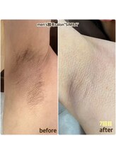 メンズ シンバ(SIMBA)/◯before→after◯