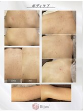 ビジュープラス 水戸店(Bijou+)&nbsp;ボディー 肌改善◎