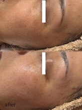 ベリス(BELLIS)/細かいシワ/ちりめんじわも♪