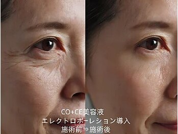 憩いサロン ユリ(yuri)/エレクトロポーレション導入