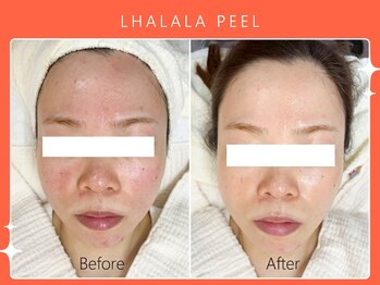 ハノハノ 八代店(HANO HANO)/韓国肌管理ララピール☆