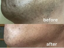 ウィステリア(WISTERIA)/髭脱毛