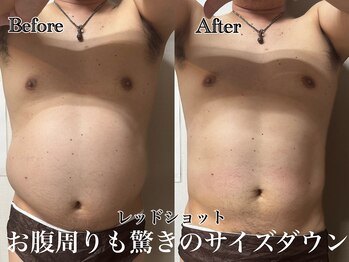 アンドエス 六本木(and S.)/最新脂肪分解でお腹もサイズdown