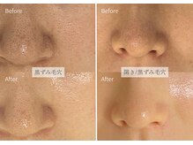 シューラディアント(ShuRadiant)の雰囲気（[毛穴レス] 施術回数を重ねるごとに効果を実感/悩み繰り返さない）