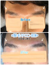リム 横浜(RIM)/眉毛脱毛