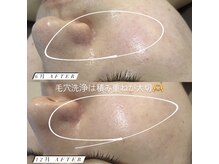 ステライチマルサン(stella.103)/ほほの赤みには光フェイシャル