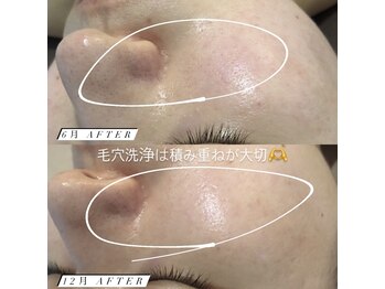 ステライチマルサン(stella.103)/ほほの赤みには光フェイシャル