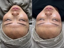 スキンラボ ドットシキブ 厚木海老名店(skinlabo .sikibu)/最新白玉ピーリング