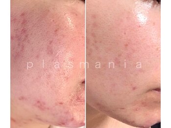 アールスタイルビューティ(R STYLE BEAUTY)/プラズマニアニキビフェイシャル