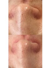 フットミー(foot mii)/即日実感