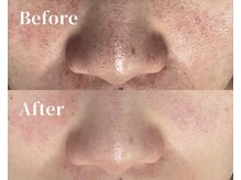 【毛穴ケア+トーンアップ】プラズマ毛穴引締めフェイシャル