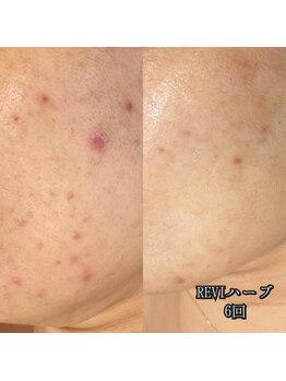 カルム エ コンポーゼ(Calme et Compose')/REVIハーブ/6回