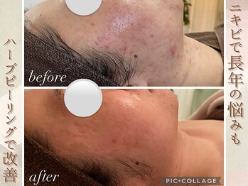 ラナ(LaNa)/にきびケア