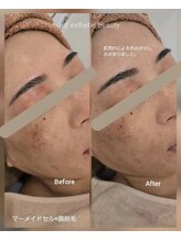 ルフ エステティック ビューティー(ruf esthetic beauty)/マーメイドセル