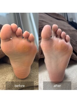 アイル(isle)/【足裏のタコでお悩み】のお客様