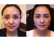 ナチュレアンドメディカ(Nature&Medica)/【小顔】オンダリフトONDA