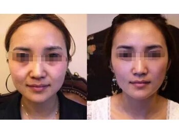 ナチュレアンドメディカ(Nature&Medica)/【小顔】オンダリフトONDA