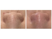 Ottimo Facial Salon/毛穴ケア