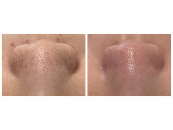 Ottimo Facial Salon/毛穴ケア