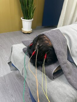 エウーゴ整骨院/じわじわ気持ちいい頭に鍼~♪