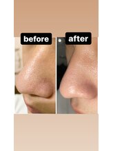 ルルン(LuLuN)/before→after