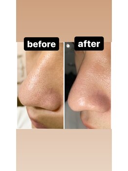 ルルン(LuLuN)/before→after