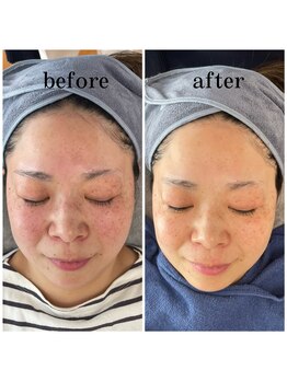 サロンピュア 所沢店/光フェイシャルモニター様♪