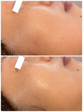 ビジュープラス つくば店(Bijou+)/毛穴レスノーファンデ肌