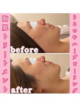 リル(Lil)/陶肌トリートメントで肌質改善