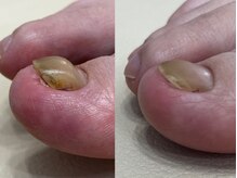 エルユーネイルズ(LUnails)/コンプレックス爪