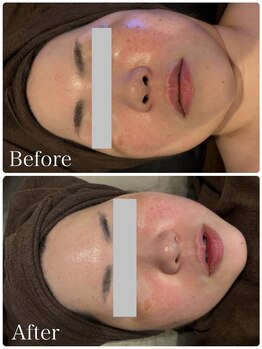 なごみ/最新◆プラズマフェイシャル4回