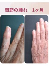 ララスマイル 鶴崎森町店/指の関節の腫れが良くなりました