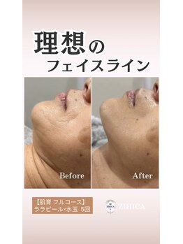 ジヒカ(ZIHICA)/【肌育フルコース】