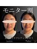 （顔）期間限定【症例モニター＆口コミ】小顔リフト美容鍼￥3,980→￥980