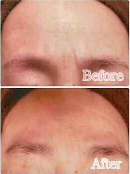 ブランシェ 金沢店 × 椿/シワ・たるみケア　お客様