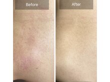 ルナート(Lunart)/ハーブピーリング【背中】