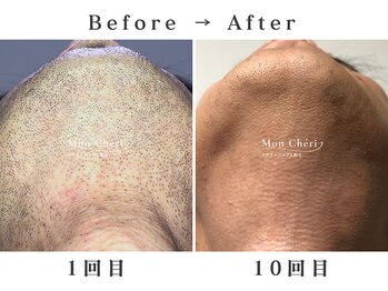モンシェリ 広島店(Mon Cheri)/ヒゲ脱毛Before→After