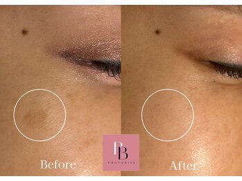 フォトビズ/フォト光シミ専用波長スポット♪