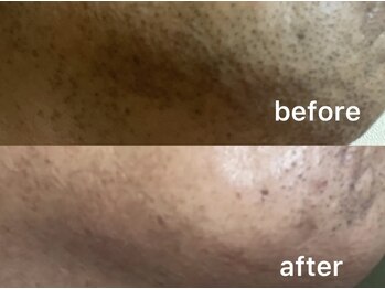 ウィステリア(WISTERIA)/ひげ脱毛